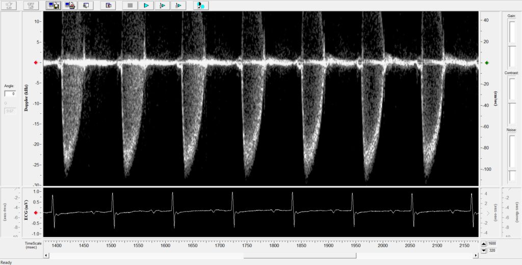Pulmonary flow Scintica