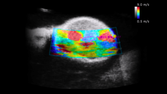 Shear wave Elastography PT2 1920x1080